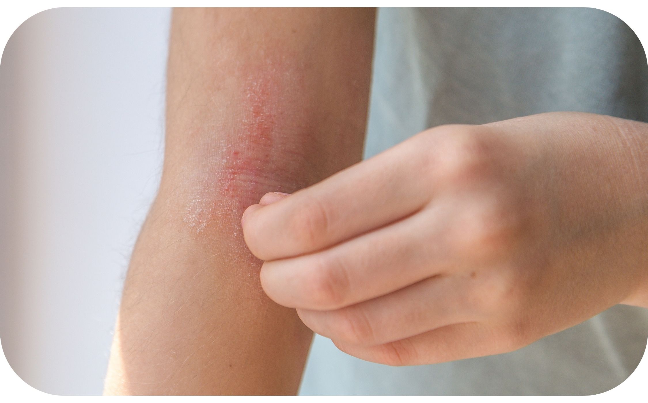 Kind kratzt an geröteter, aufgekratze Neurodermitis-Stelle in der Armbeuge