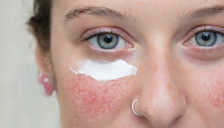 Frau mit Rötungen auf der Wange und Rosacea Hautpflege Creme im Gesicht