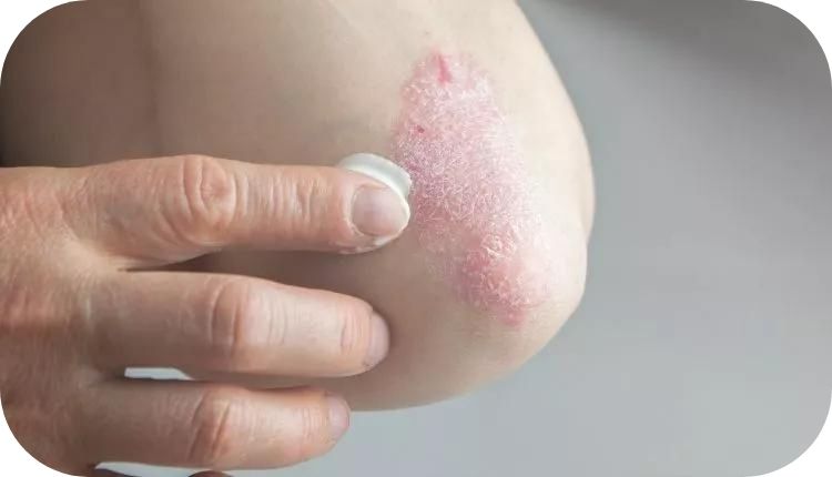 Schuppenflechte (Psoriasis)