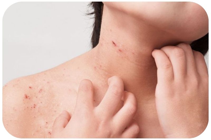 Kind mit Neurodermitis Symptomen Juckreiz und Ekzeme