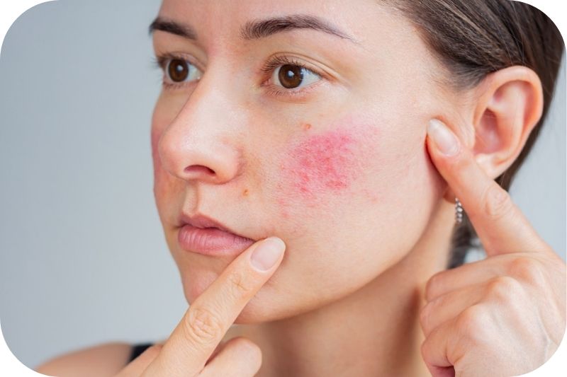 Frau mit Rosacea: Sichtbare Rötungen, Äderchen und Pusteln auf der Wange