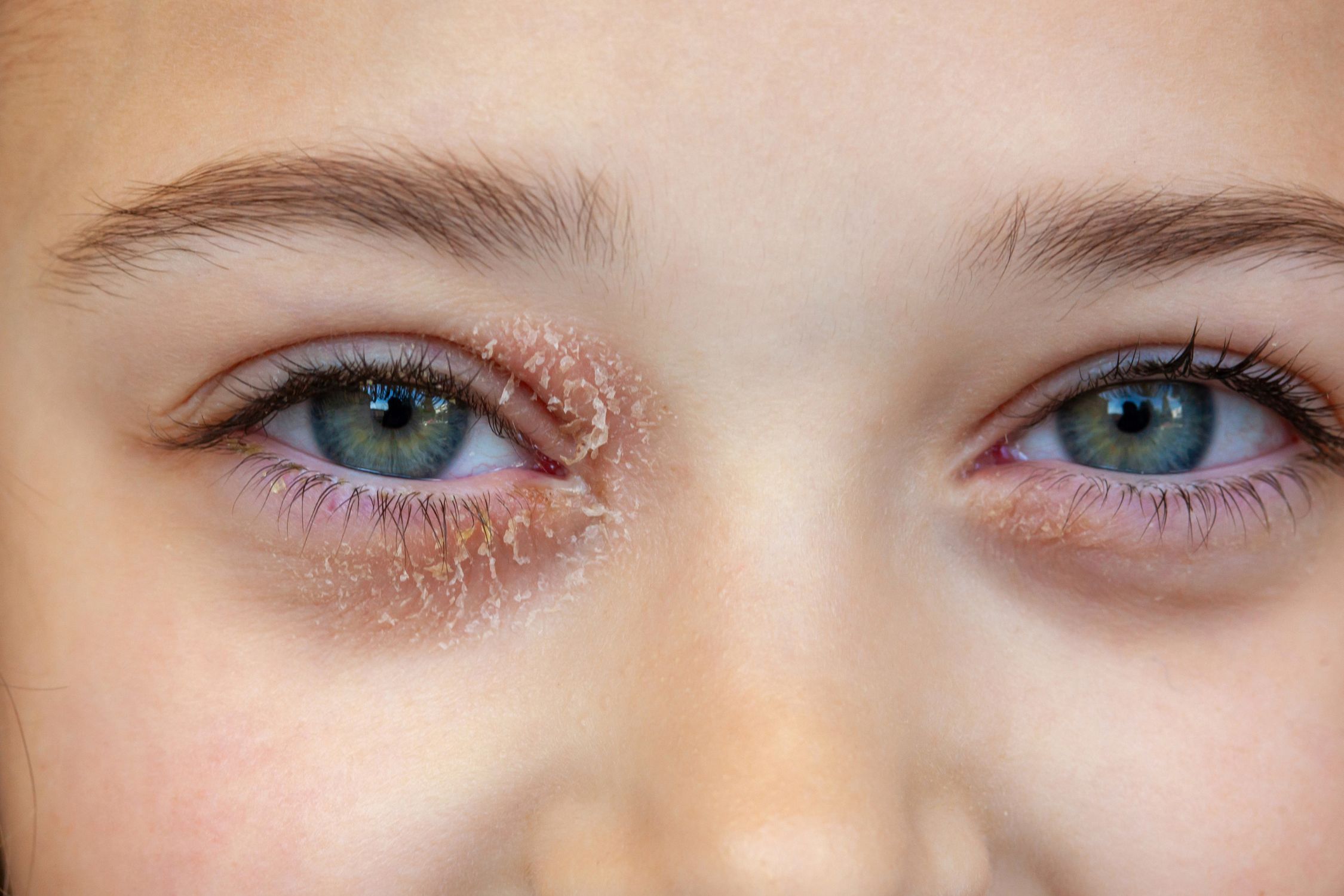 Neurodermitis am Auge: Schuppige und gerötete Haut an den Augen