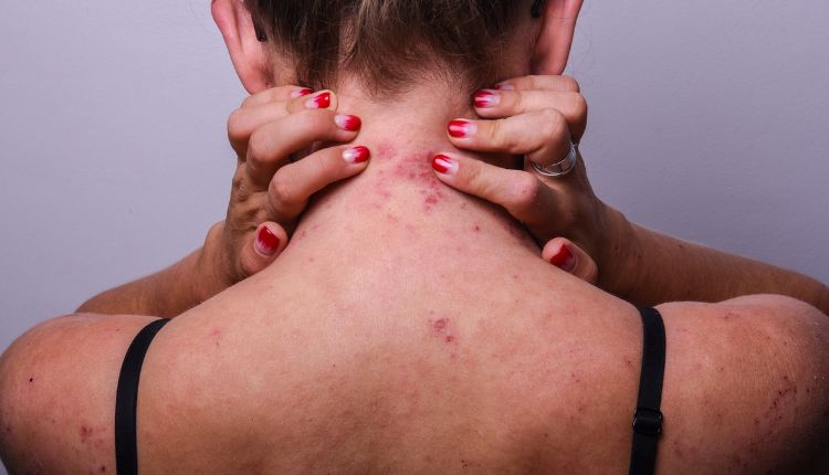 Erwachsene Frau mit Neurodermitis auf Hals, Rücken und Schultern