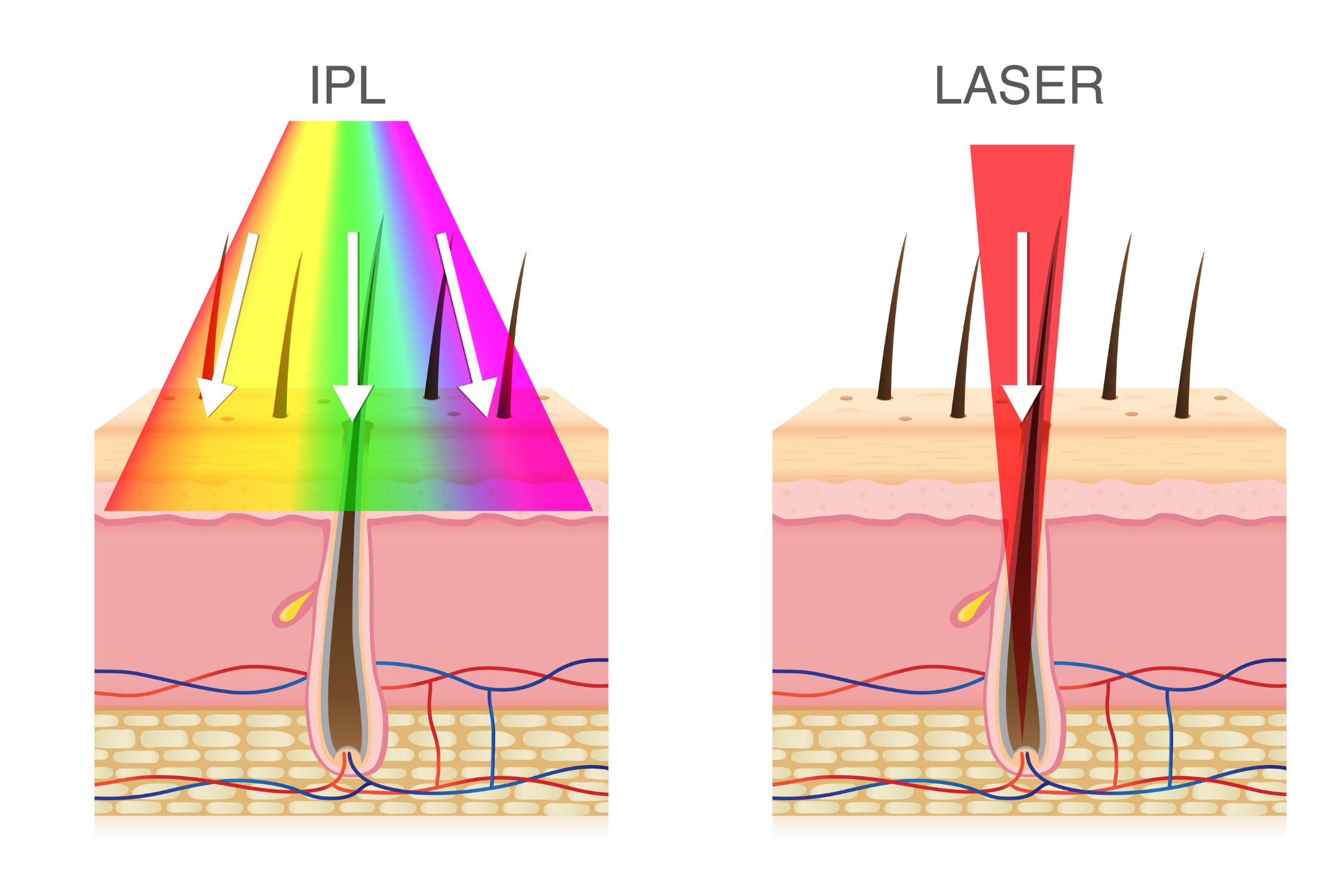 Grafik: Unterschied zwischen IPL und Laser