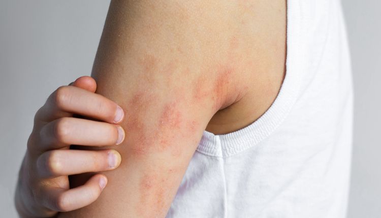 Oberarm und Achsel eines Jugendlichen mit sichtbaren Neurodermitis Stellen