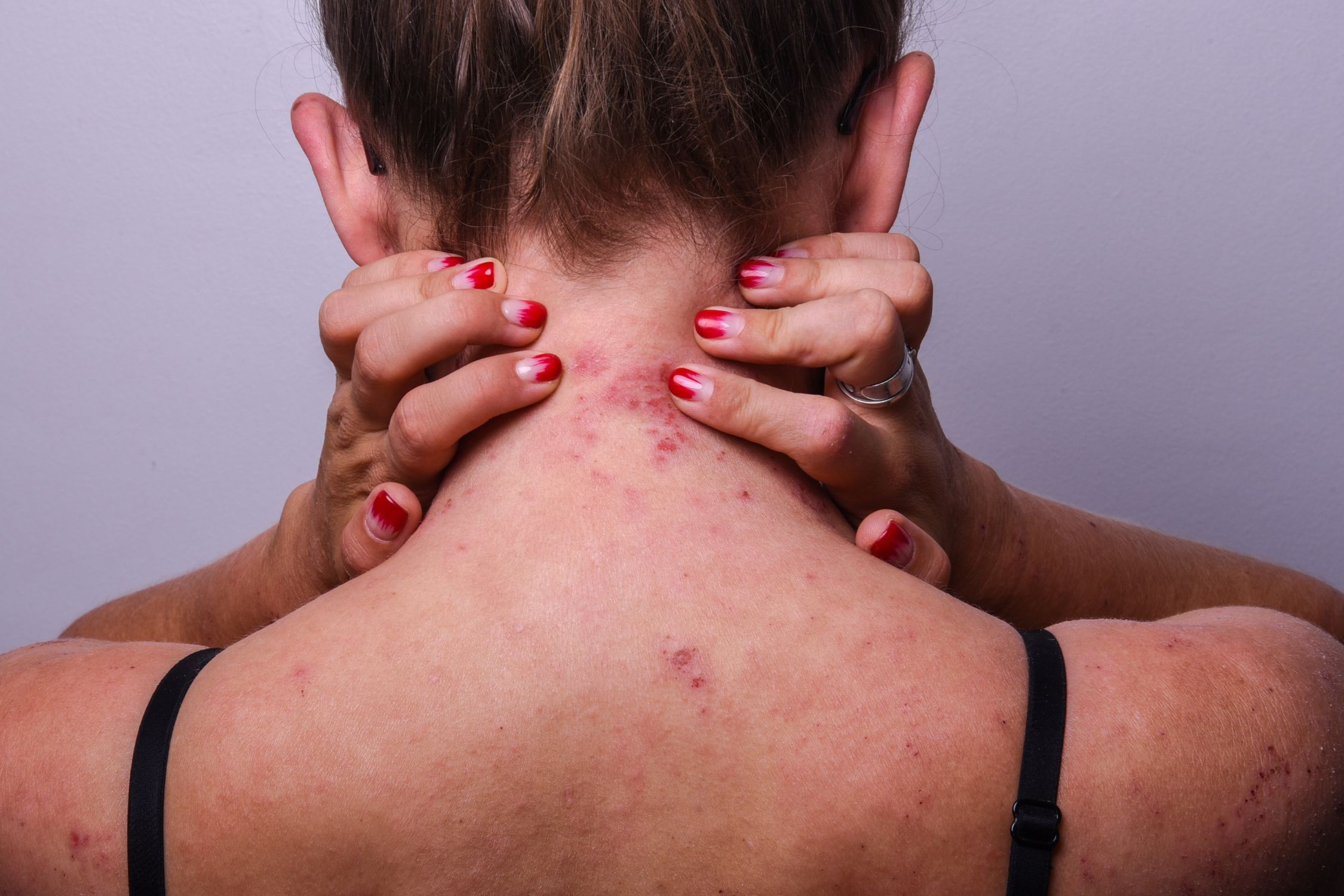Erwachsene Frau mit Neurodermitis auf Hals, Rücken und Schultern