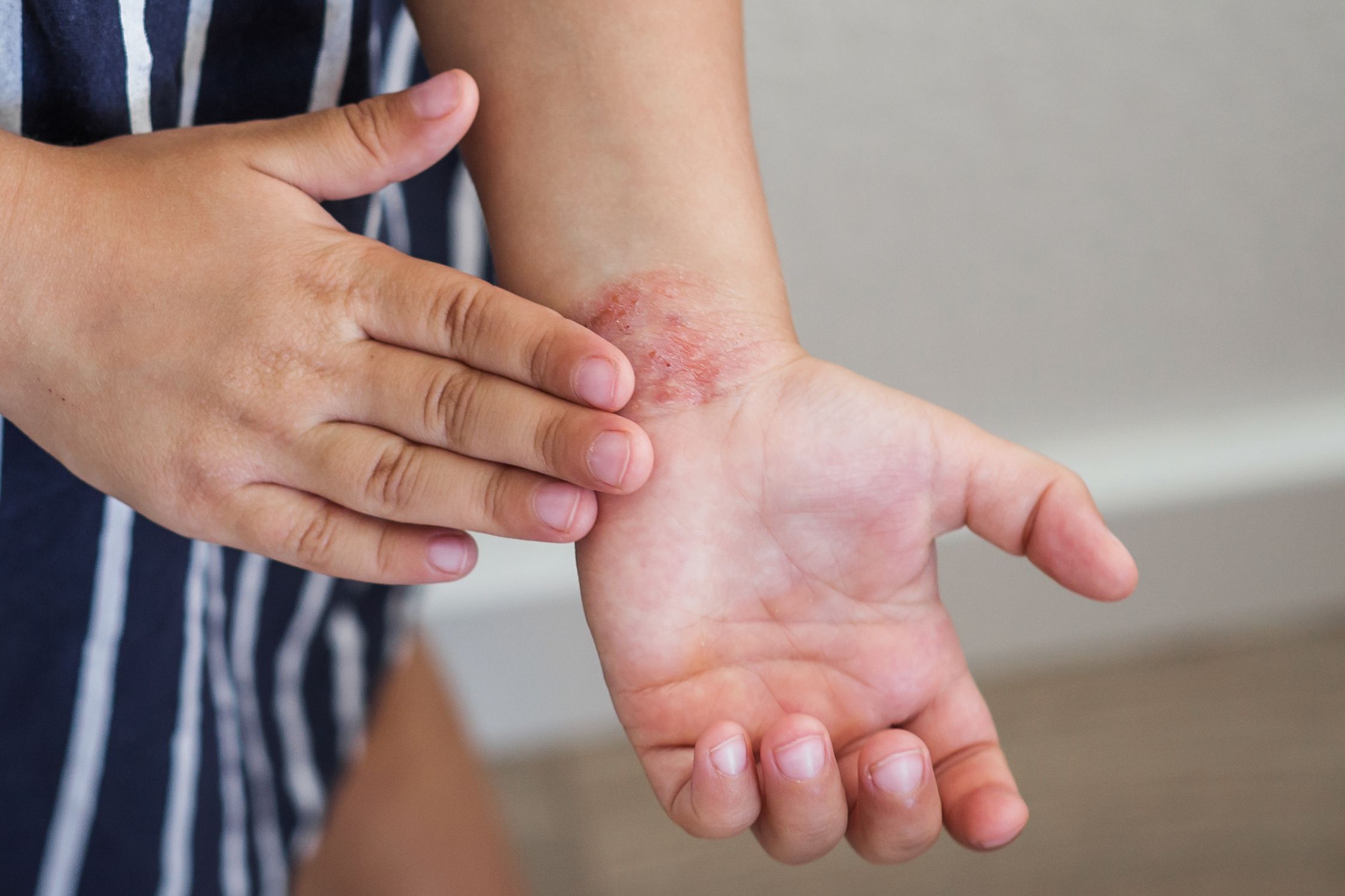 Kind mit Neurodermitis am Handgelenk