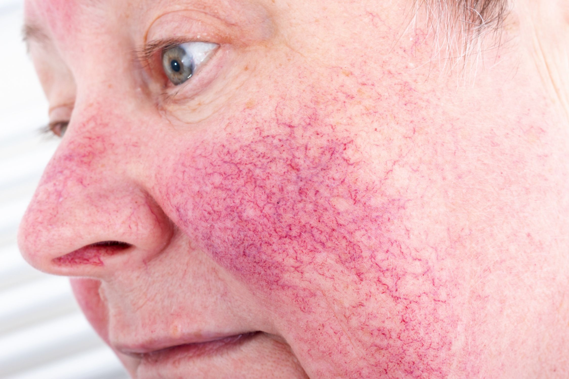 Frau mit Rosacea im Spätstadium im Gesicht