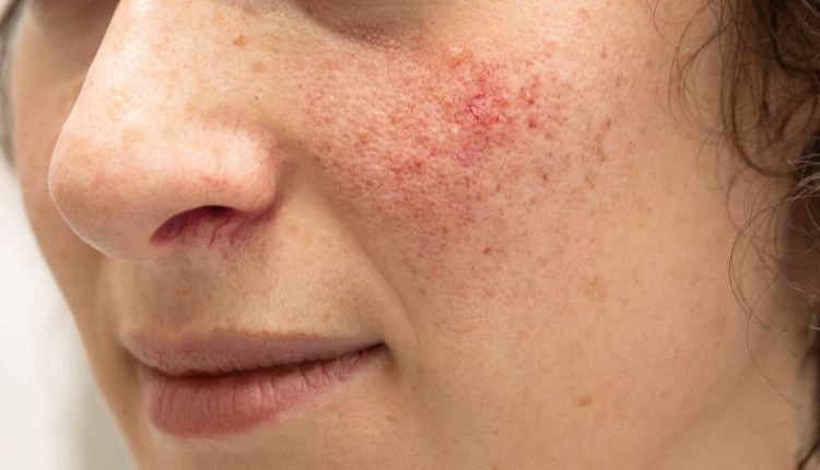 Frau mit Rosacea Symptomen, Anzeichen wie Rötungen, Äderchen und Pusteln
