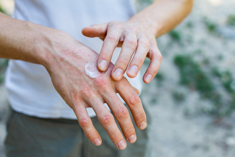Mann mit Psoriasis cremt sich die Hand ein