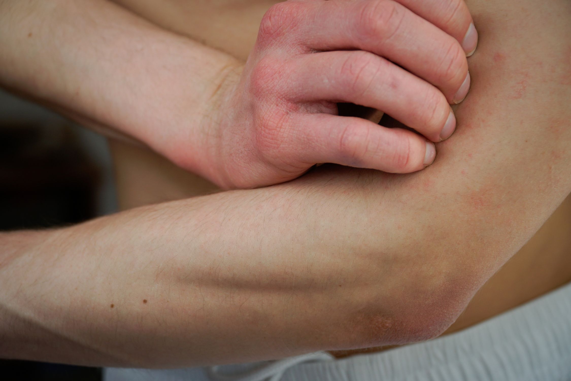 Mann mit Neurodermitis kratzt sich am Arm