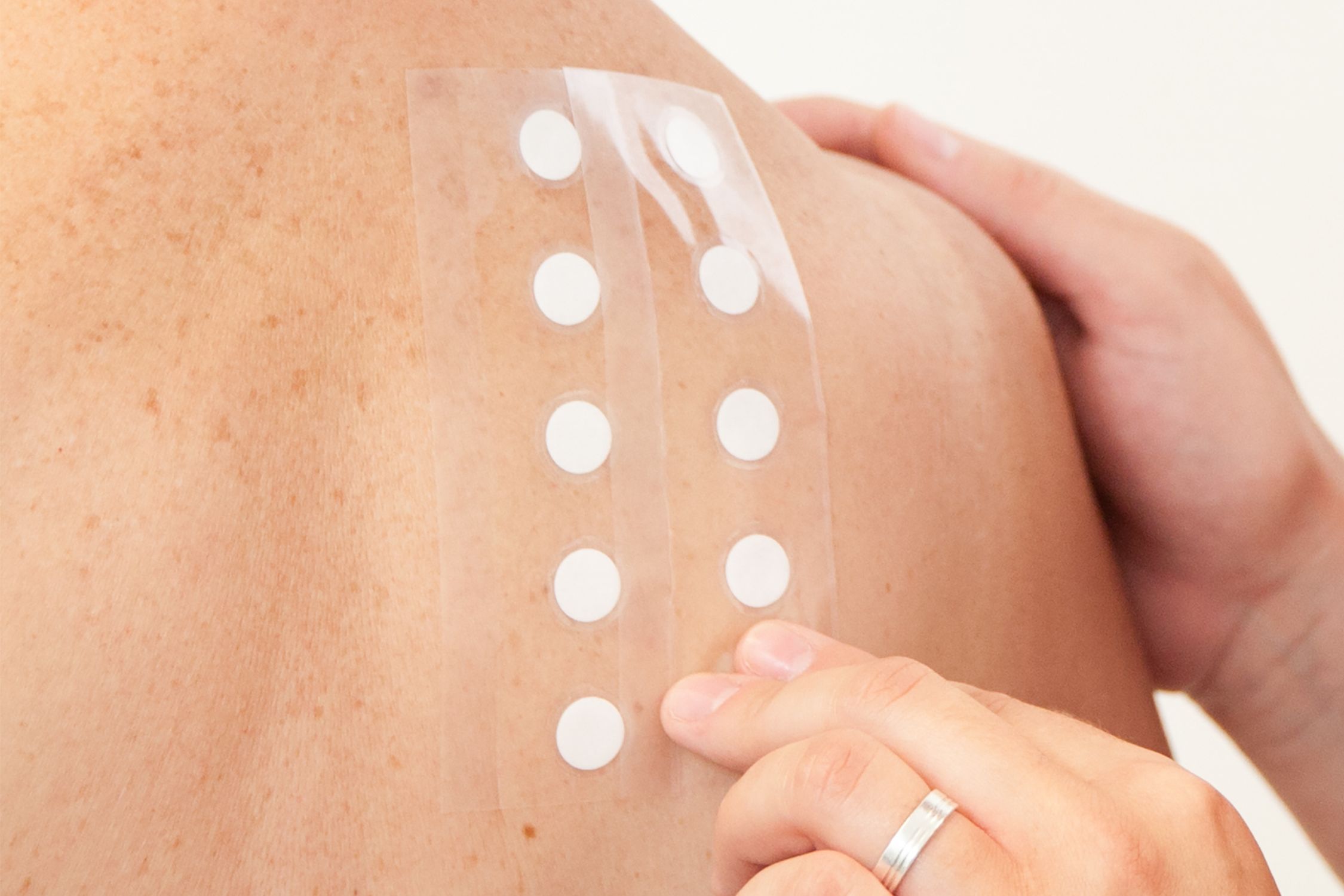 Pflaster für Epikutantest zur Allergietestung auf dem Rücken