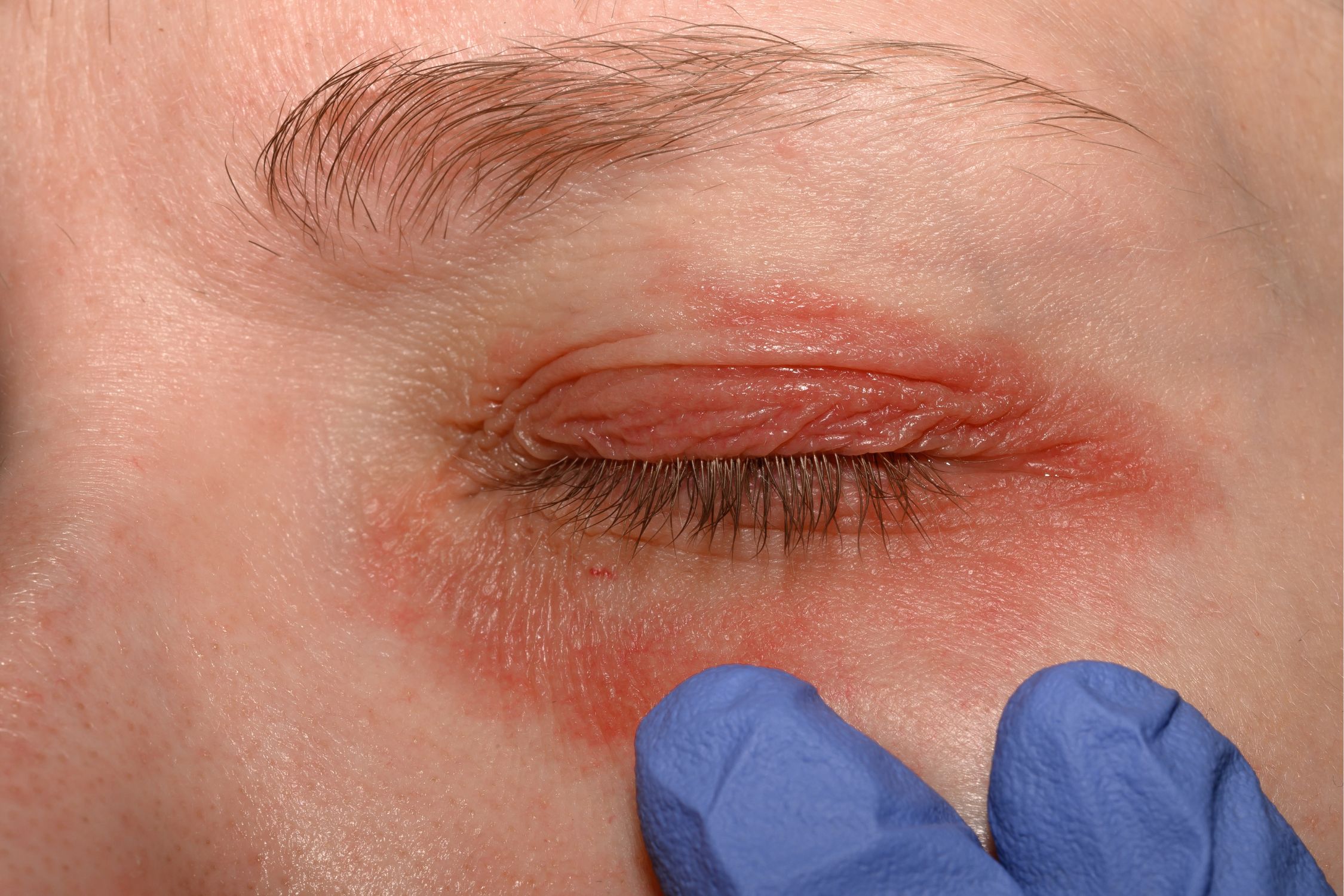 Hand eines Arztes mit Handschuhen untersucht Neurodermitis am Auge