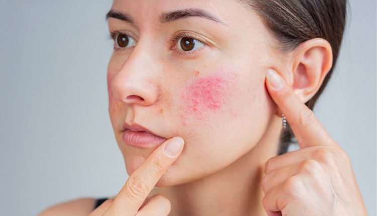 Frau mit Rosacea: Sichtbare Rötungen, Äderchen und Pusteln auf der Wange