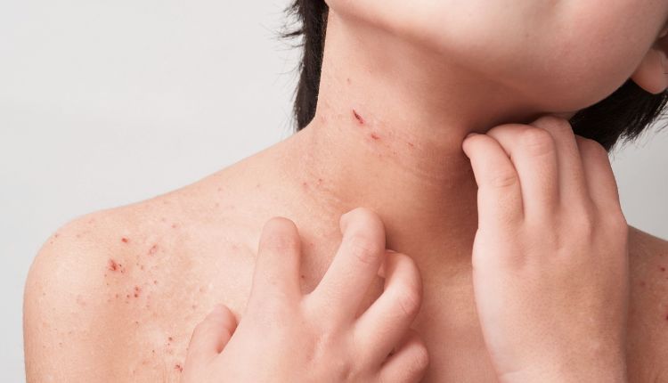 Kind mit Neurodermitis Symptomen Juckreiz und Ekzeme