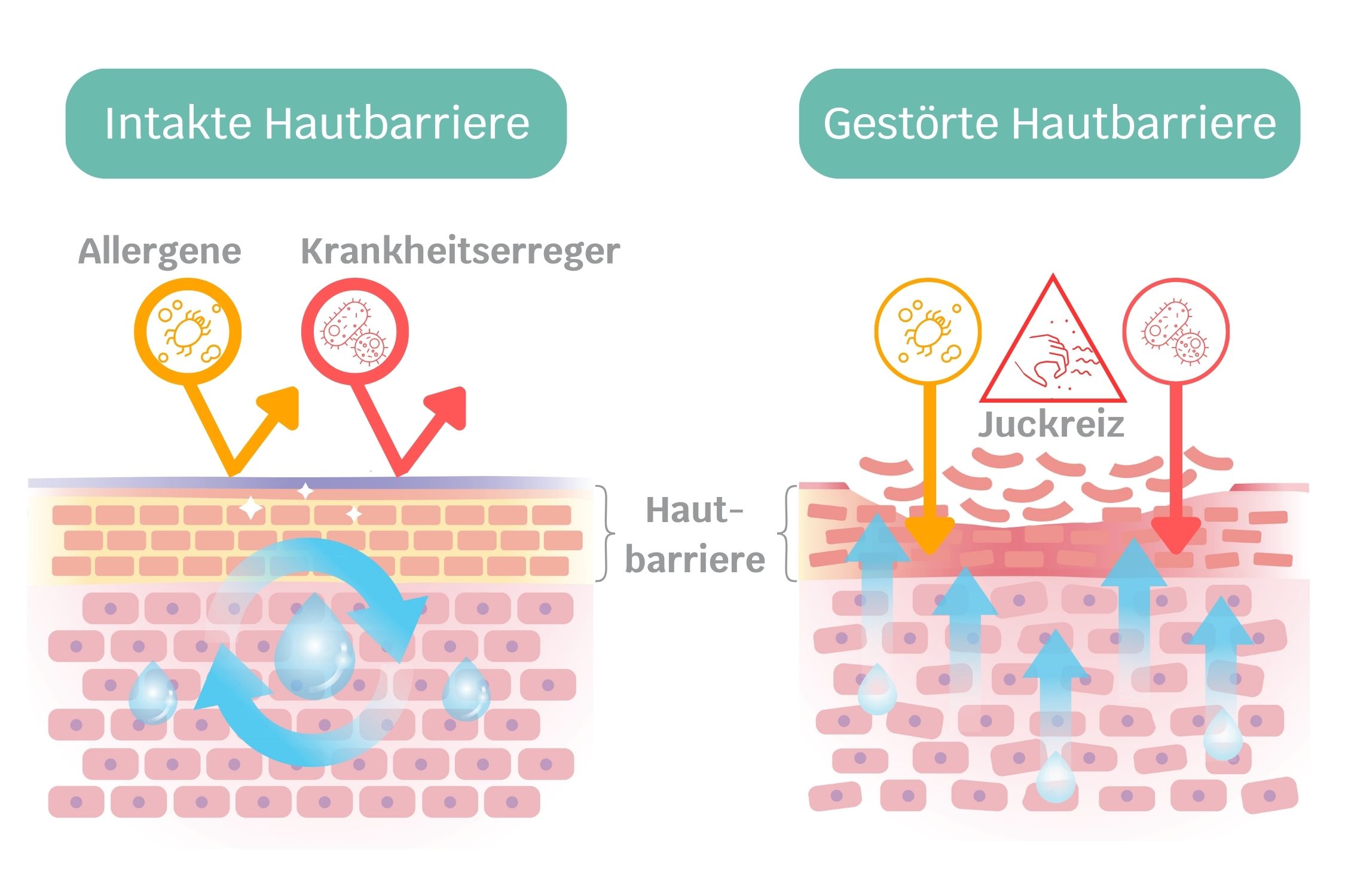 Grafik: Links die intakte, schützende Hautbarriere, rechts die gestörte, durchlässige Hautbarriere