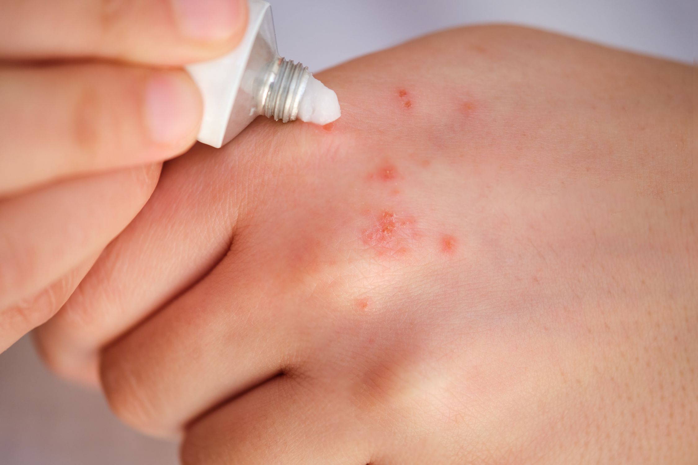 Person mit Neurodermitis trägt Kortisoncreme auf Ekzem an der Hand auf