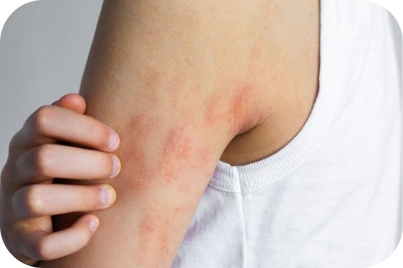 Oberarm und Achsel eines Jugendlichen mit sichtbaren Neurodermitis Stellen