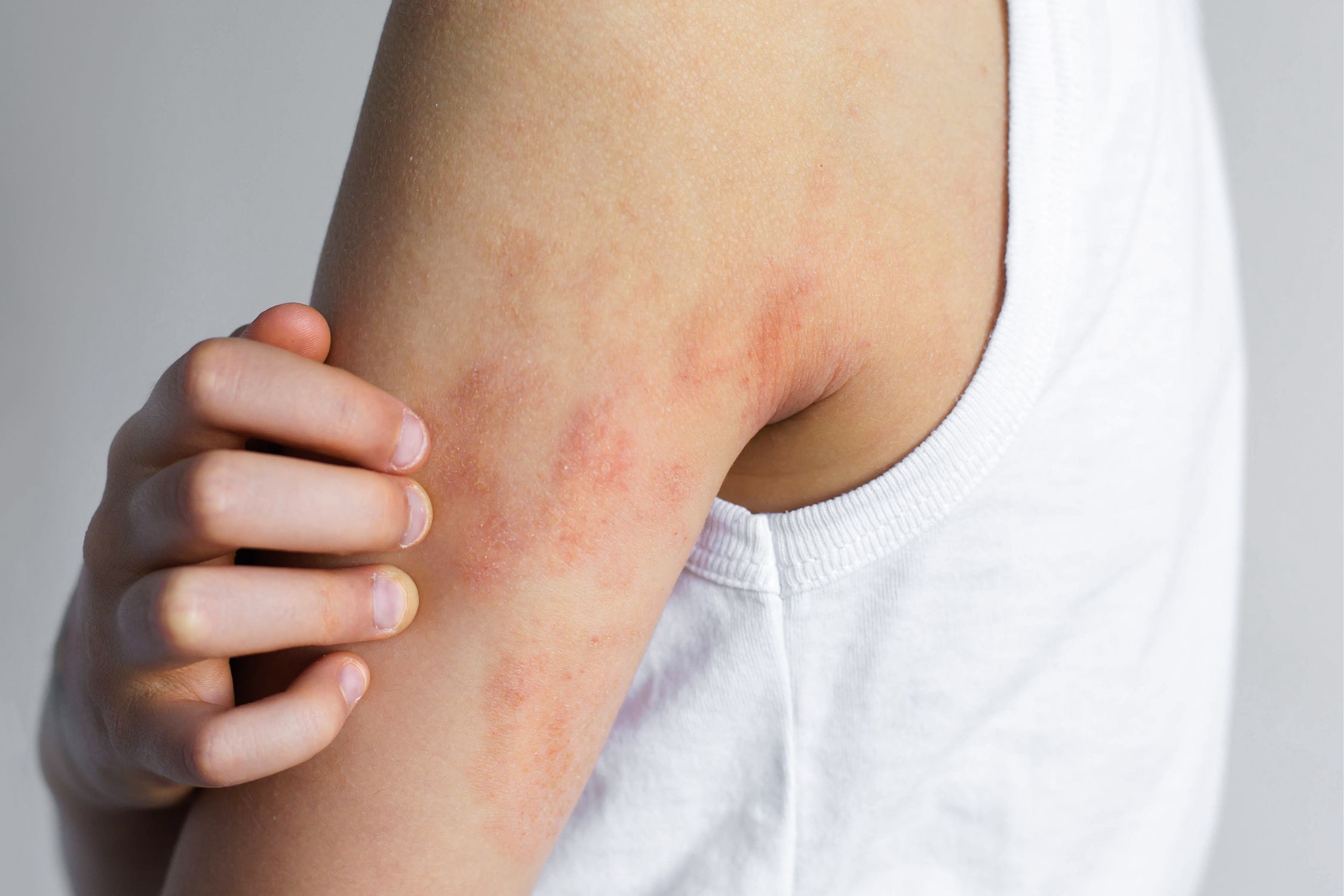 Oberarm einer Jugendlichen mit Neurodermitis-Symptomen und Ekzemen