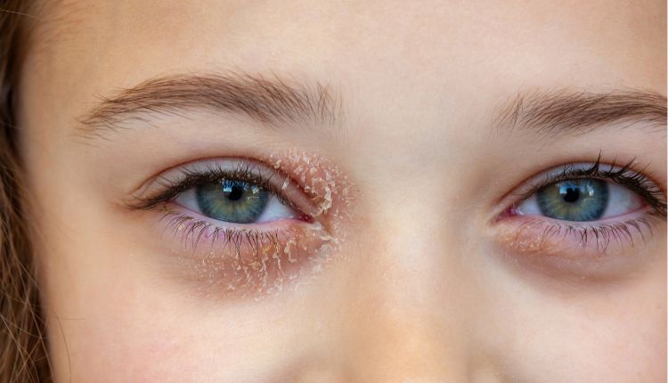 Neurodermitis am Auge: Schuppige und gerötete Haut an den Augen