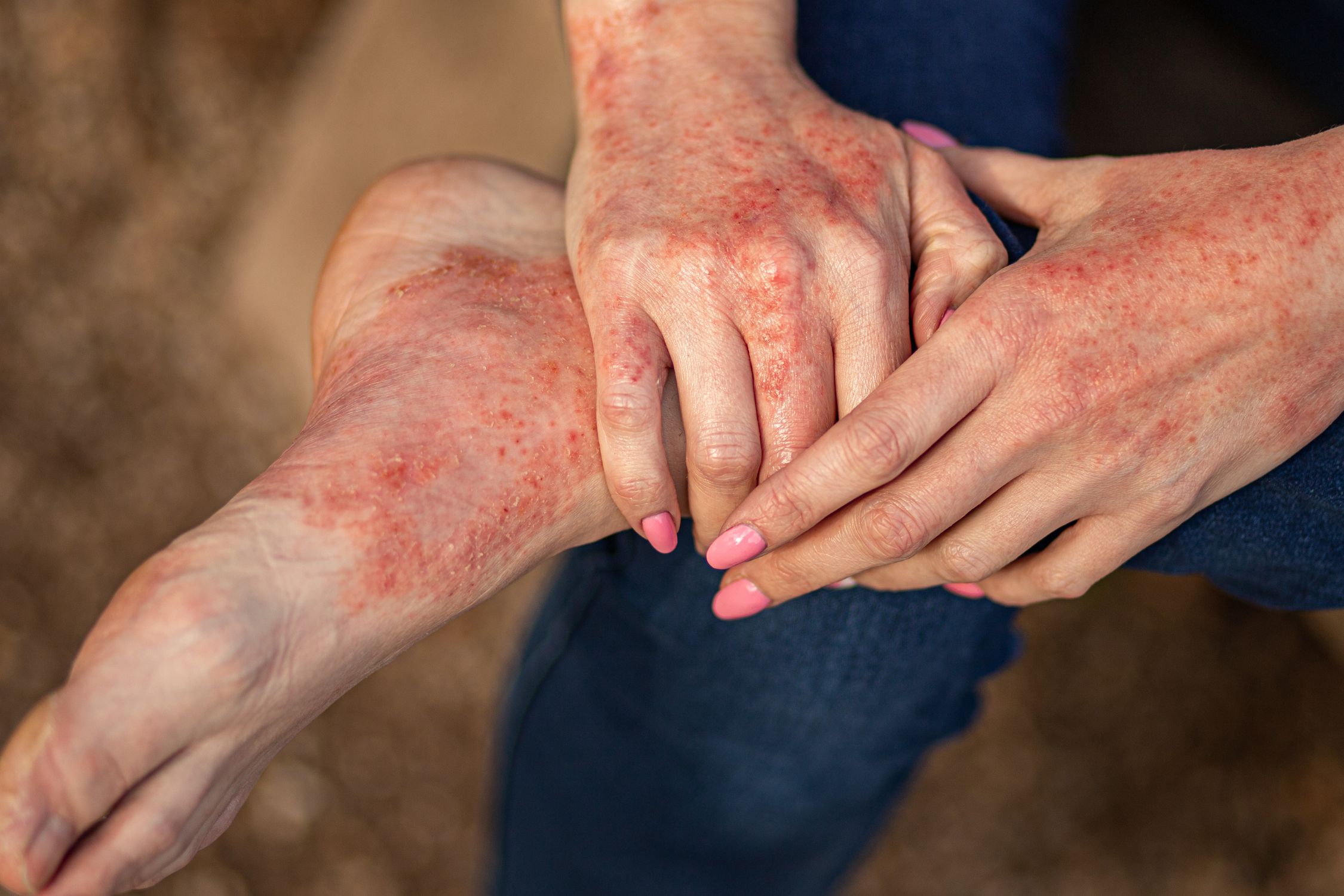Erwachsene Frau mit Neurodermitis an Händen und Füßen