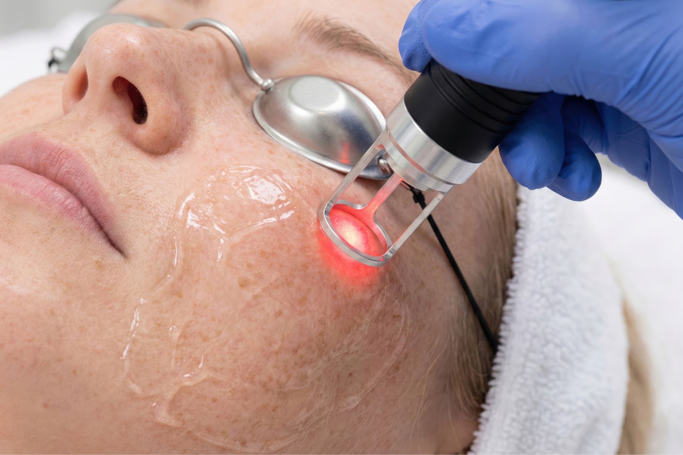 Frau bekommt eine Laserbehandlung im Gesicht
