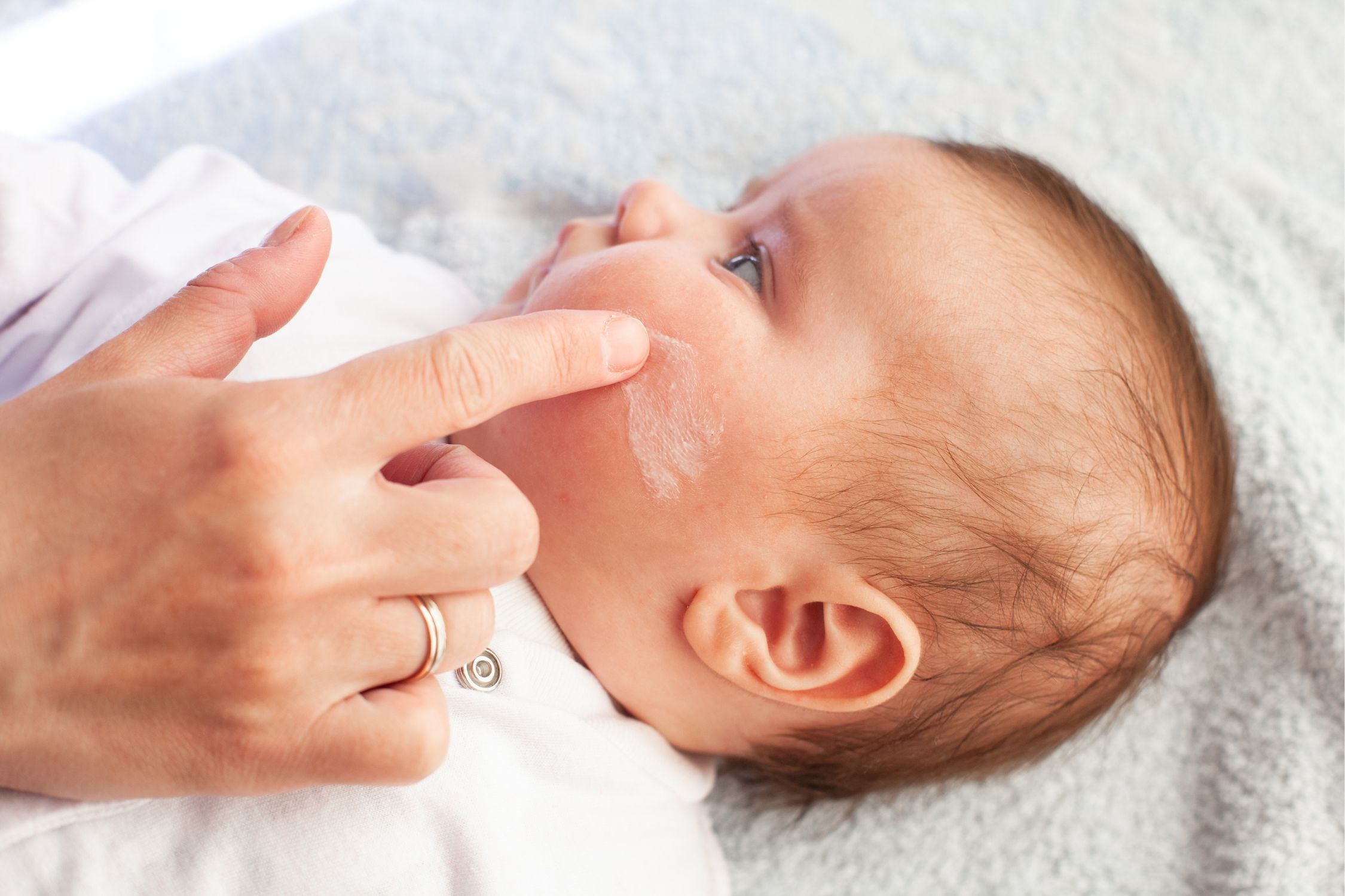 Neugeborenes Baby mit Neurodermitis wird eingecremt im Gesicht