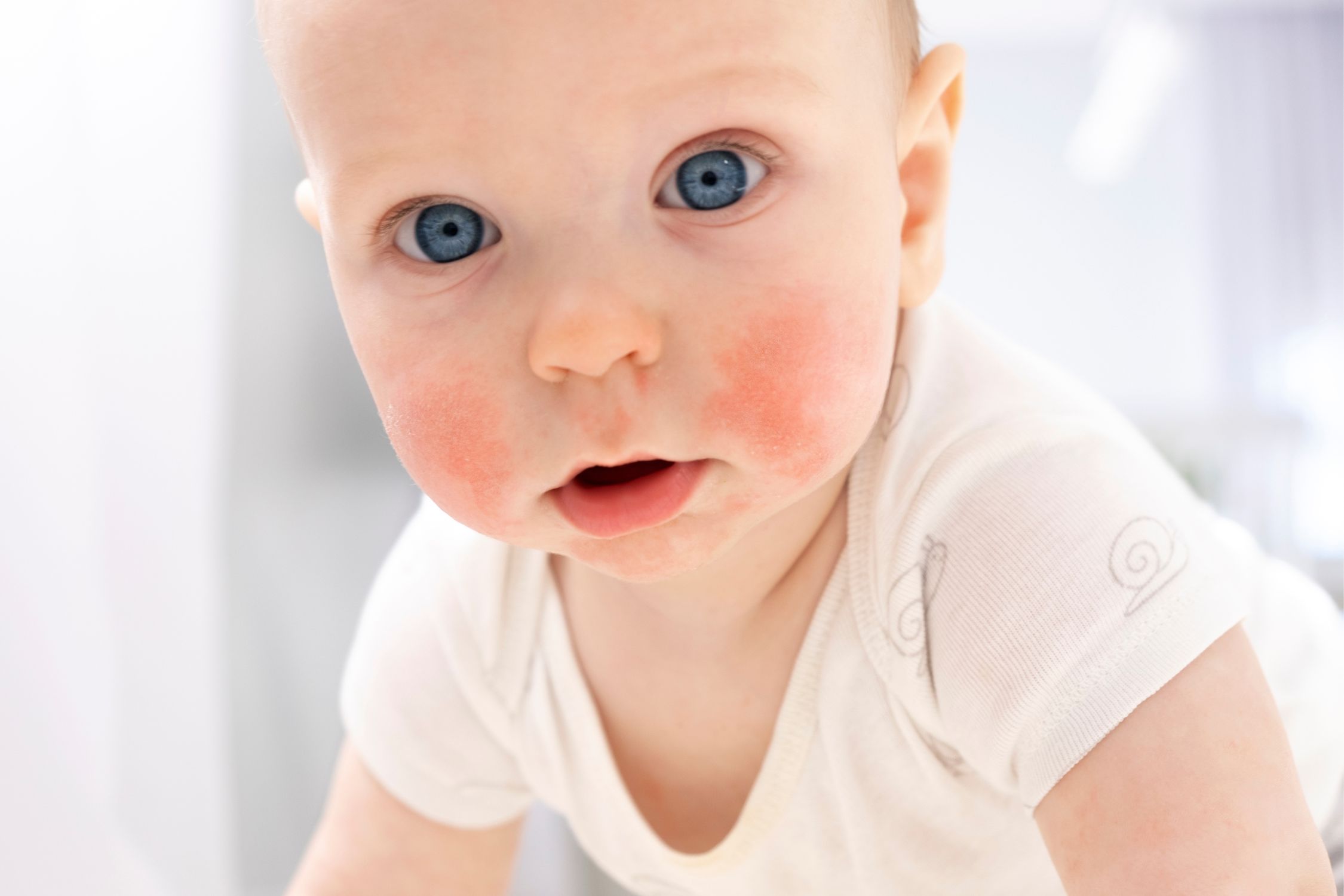 Baby mit Neurodermitis schaut neugierig in die Kamera