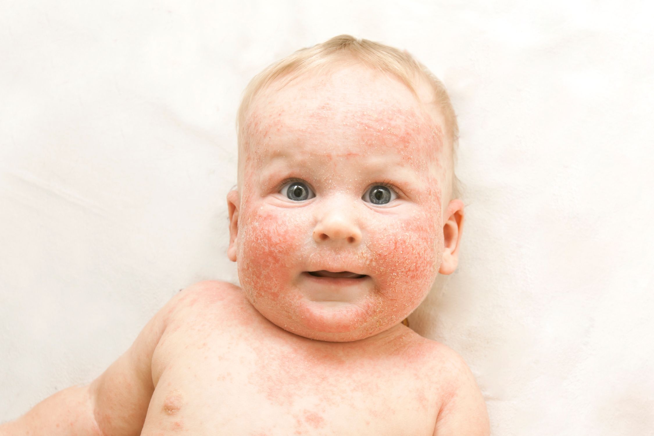 Baby mit Neurodermitis im Gesicht und am Rumpf