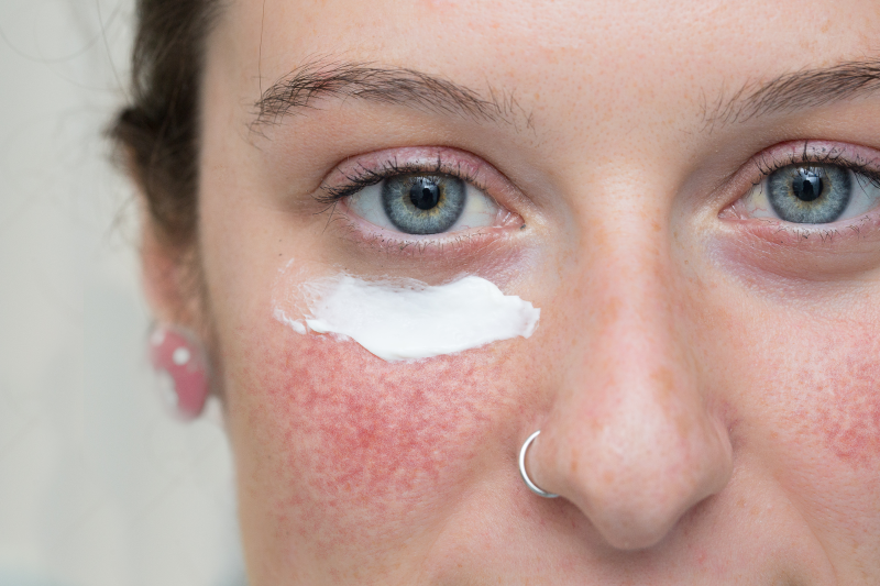 Frau mit Couperose verwendet Hautcreme im Gesicht