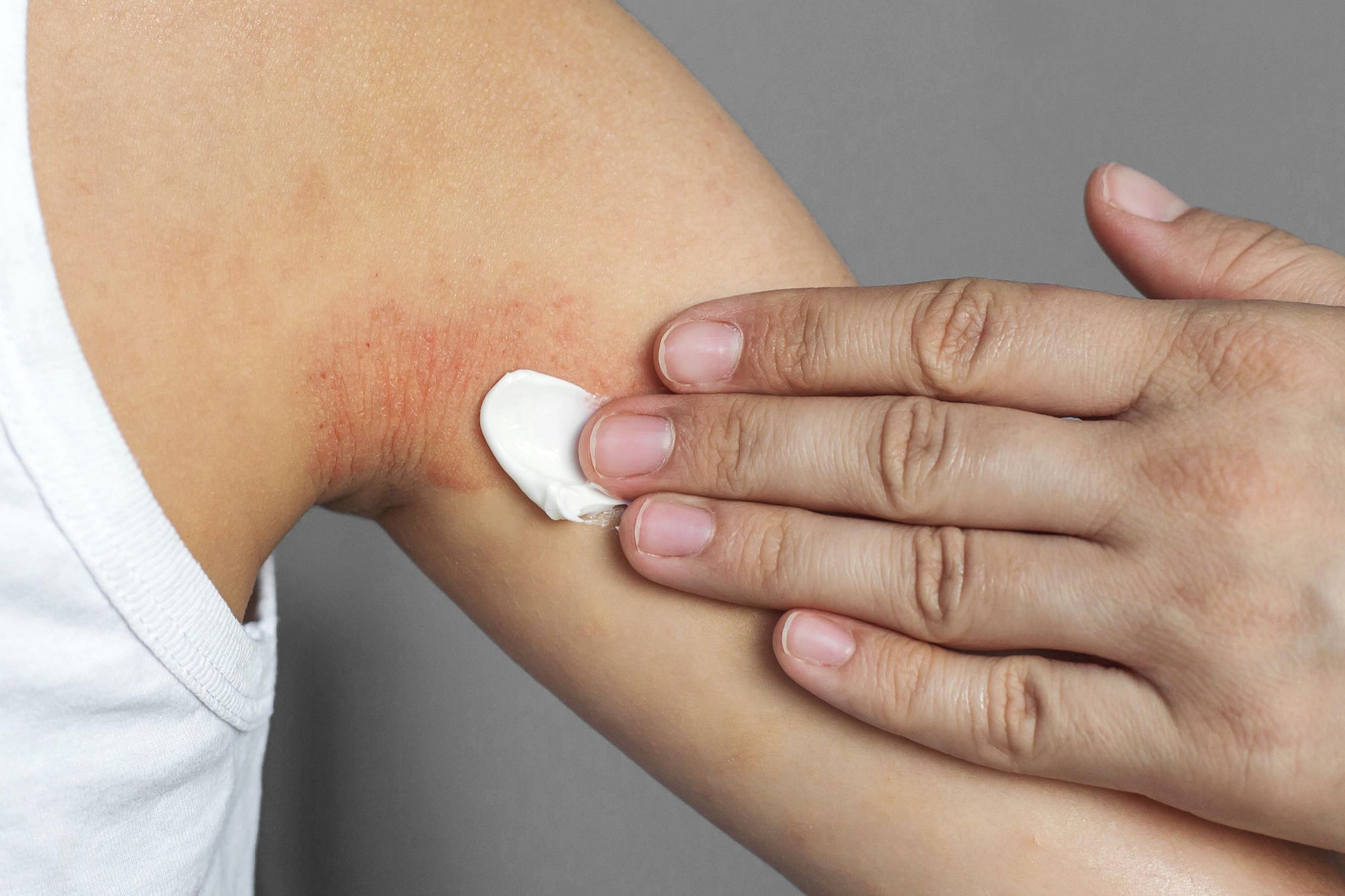 Hand trägt Creme auf Neurodermitis Stelle in der Achsel eines Jugendlichen auf